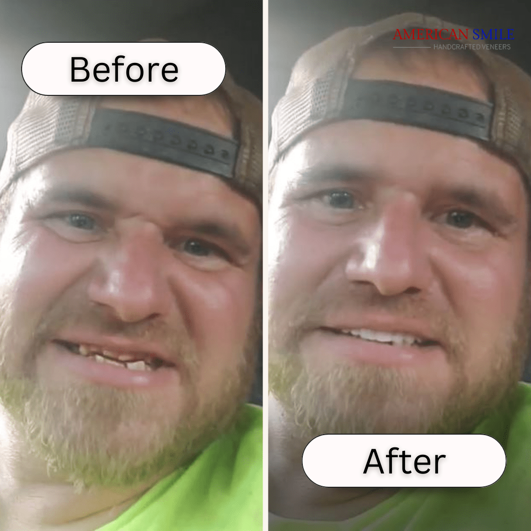 American Smile Veneer (Lower Only)