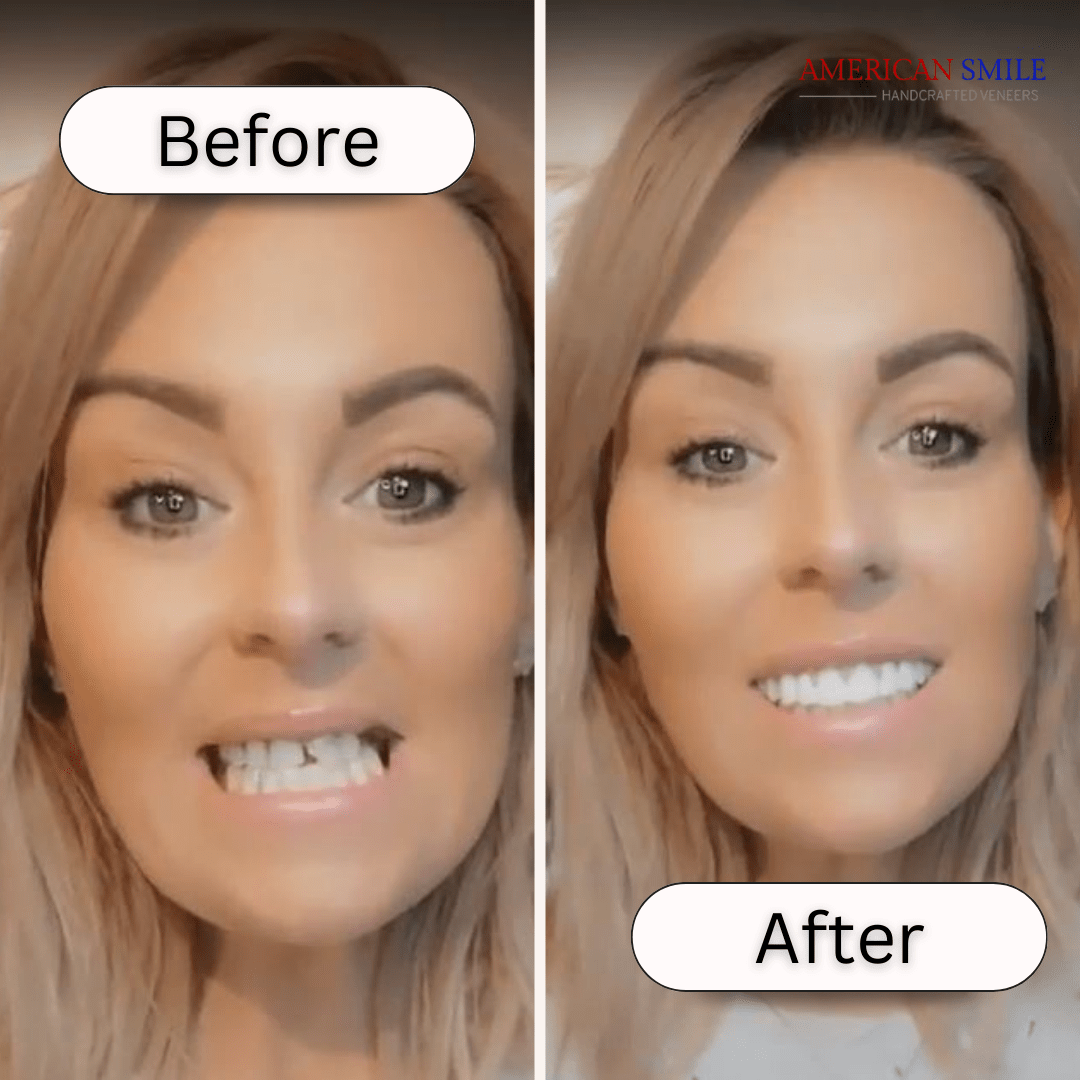 American Smile Veneer (Upper Only)