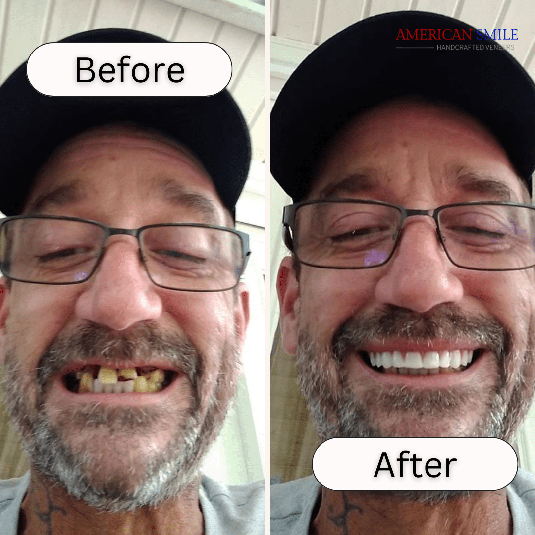 American Smile Veneer (Upper Only)