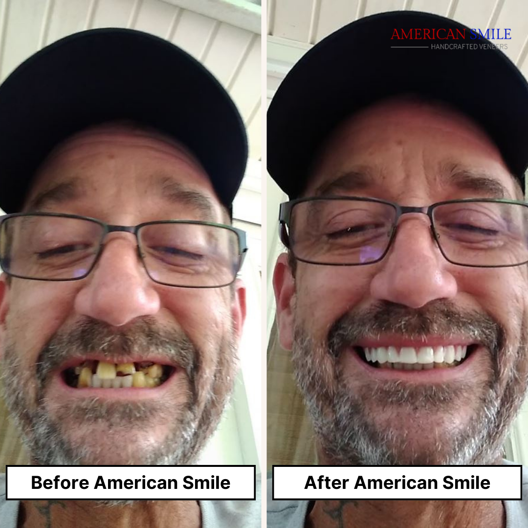 American Smile Veneer