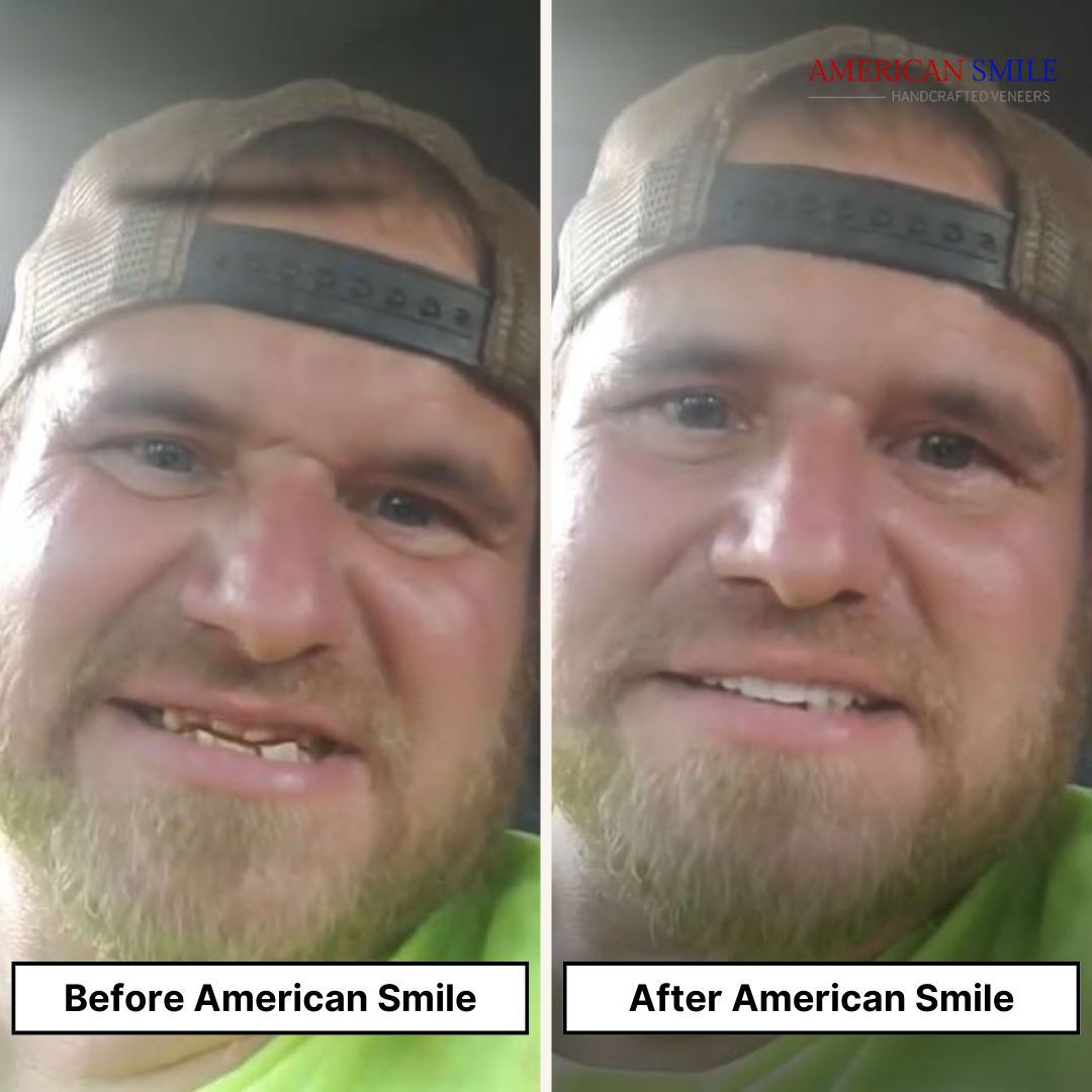 American Smile Veneer